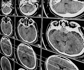 Traumatic Brain Injury Image